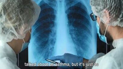 Unraveling BOOP- A Deep Dive into BRONCHIOLITIS OBLITERANS Organ