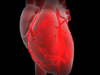 What is a myocardial infarction or heart attack