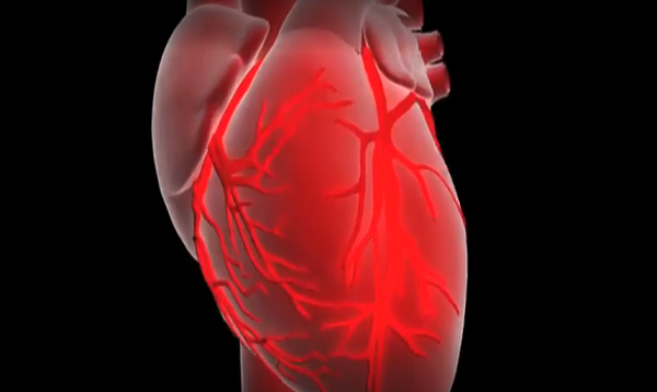 What is a myocardial infarction or heart attack