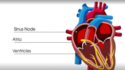 What is atrial fibrillation