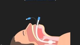 Anatomy of the Endotracheal Tube ET Tube Airway Management