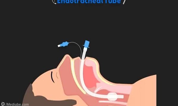 Anatomy of the Endotracheal Tube ET Tube Airway Management