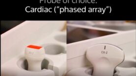 Basic Transthoracic Echocardiography Cardiac Ultrasound TTE Made