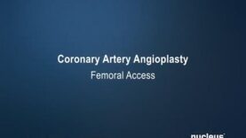 Coronary Angioplasty (Femoral Access)