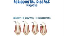 Diagnosis of Periodontitis