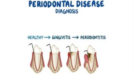 Diagnosis of Periodontitis