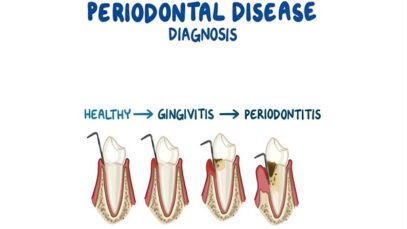 Diagnosis of Periodontitis