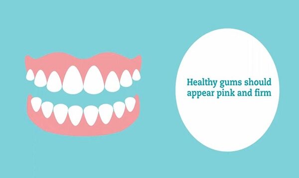 Explaining gum disease