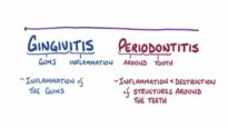 Gingivitis and periodontitis causes, symptoms, diagnosis, trea
