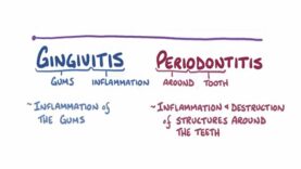 Gingivitis and periodontitis causes, symptoms, diagnosis, trea