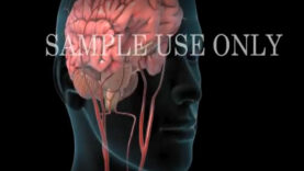 Hemorrhagic-Stroke-(Brain-Hemorrhage)