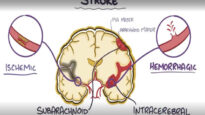 Hemorrhagic-stroke-intracerebral-hemorrhage-causes,-symptoms