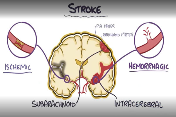 Hemorrhagic-stroke-intracerebral-hemorrhage-causes,-symptoms