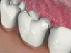 Periodontal Disease