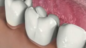Periodontal Disease