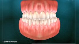 Periodontitis – Gum Disease