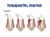 Risk Factors for Periodontitis