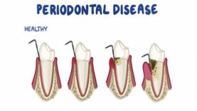 Risk Factors for Periodontitis
