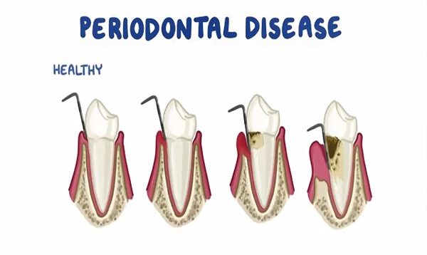 Risk Factors for Periodontitis