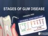 What are the Stages of Gum Disease