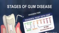 What are the Stages of Gum Disease
