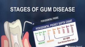 What are the Stages of Gum Disease
