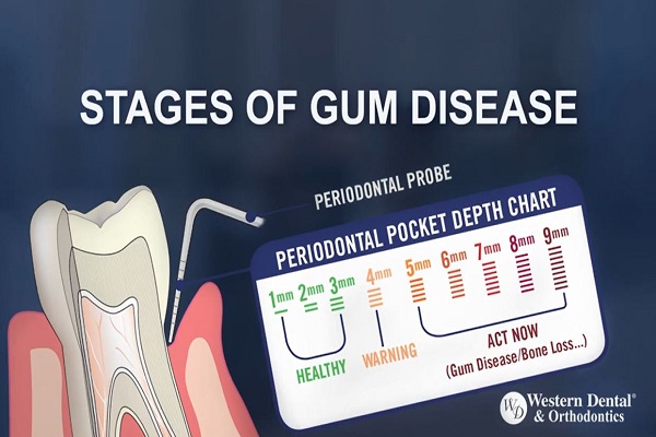 What are the Stages of Gum Disease