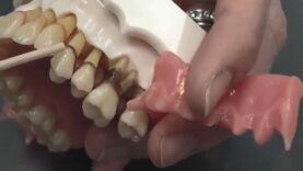 What is Periodontal Disease