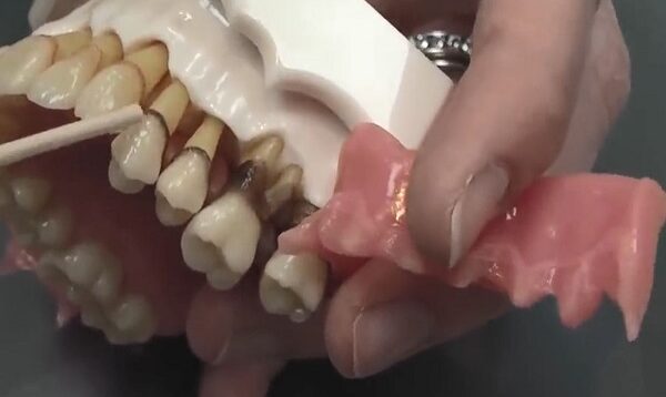 What is Periodontal Disease