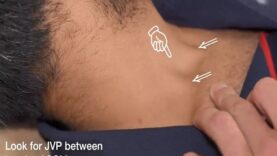 Examination of the Jugular Venous Pressure JVP Clinical Exam