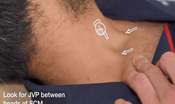Examination of the Jugular Venous Pressure JVP Clinical Exam