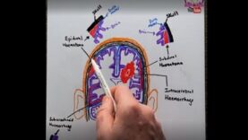 Intracranial Haemorrhage