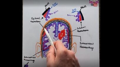 Intracranial Haemorrhage