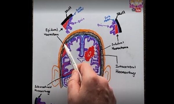 Intracranial Haemorrhage