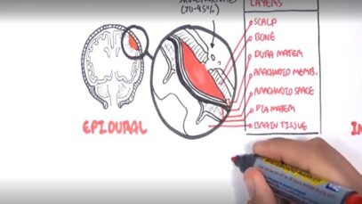 Intracranial Haemorrhage Types, signs and symptoms