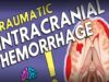 Intracranial Hemorrhage