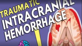 Intracranial Hemorrhage