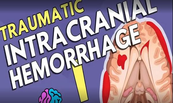 Intracranial Hemorrhage