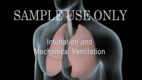 Intubation Mechanical Ventilation (Ventilator)
