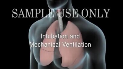 Intubation Mechanical Ventilation (Ventilator)