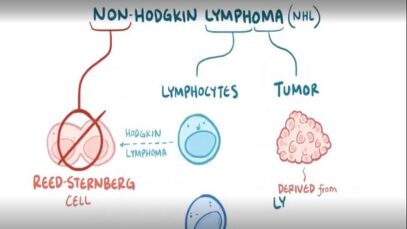 Non hodgkin lymphoma causes, symptoms, diagnosis, treatment
