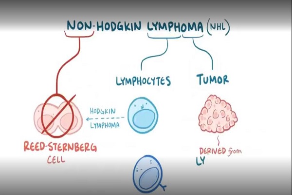 Non hodgkin lymphoma causes, symptoms, diagnosis, treatment