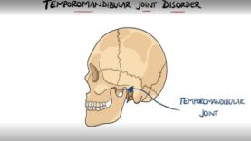 Temporomandibular Joint Disorder Explained TMJ Dysfunction I