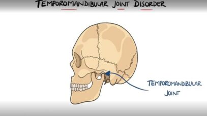 Temporomandibular Joint Disorder Explained TMJ Dysfunction I