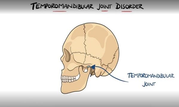 Temporomandibular Joint Disorder Explained TMJ Dysfunction I