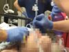 Using the Bougie for Endotracheal Intubation
