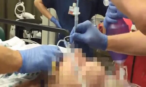 Using the Bougie for Endotracheal Intubation