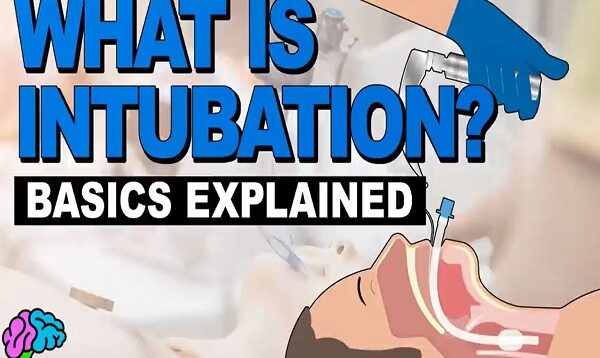 What is Intubation