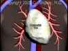 Aortic Dissection and Cardiac Tamponade