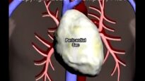 Aortic Dissection and Cardiac Tamponade